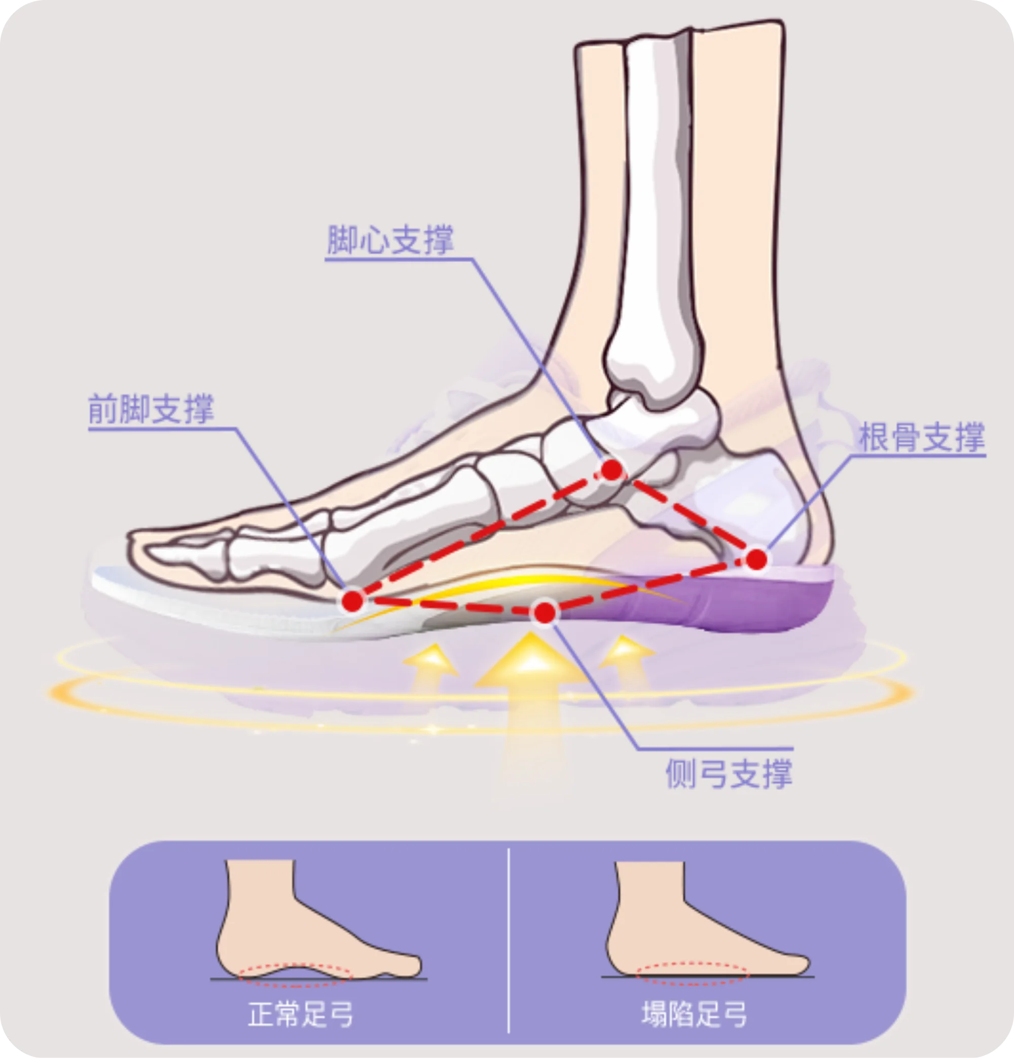 足弓支撑与塌陷示意图